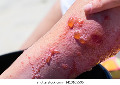 Pointing At Severe Allergic Reaction To Poison Ivy On A Woman's Arm. Blisters, Swollen Redness, And Oozing From Poison Ivy Skin Reaction.