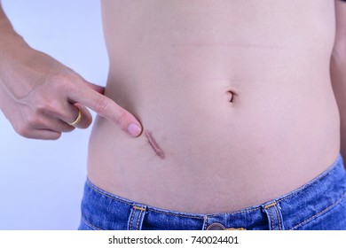 Pointing, Showing Appendix Scar At Abdomen Isolated On White Background.