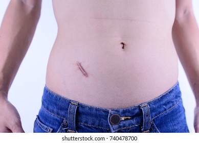 Pointing, Showing Appendix Scar At Abdomen Isolated On White Background.