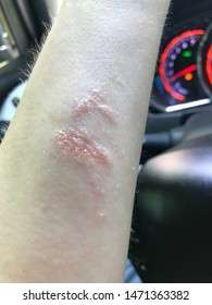 Poison Ivy Allergy On Arm