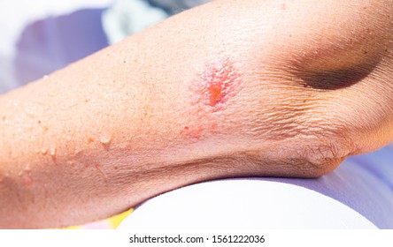 Poison Ivy Boil On Arm