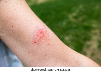 Poison Ivy Or Poison Oak Blister And Oozing Spot On Woman's Arm.