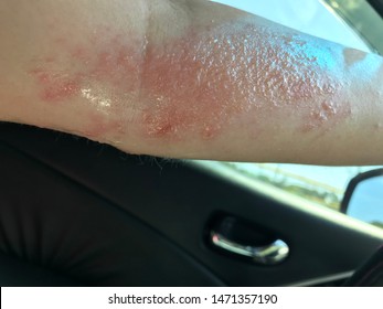 Poison Ivy On Left Arm