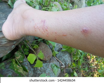 Poison Ivy Rash On Human Skin