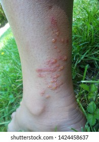 Poison Ivy Rash On Human Skin