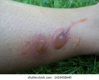 Poison Ivy Rash On Human Skin