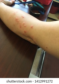 Poison Ivy Rash On Skin