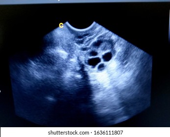 Poly Cystic Ovary By Ultrasound Scan