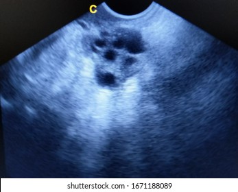 poly cystic ovary by ultrasound scan - Shutterstock ID 1671188089