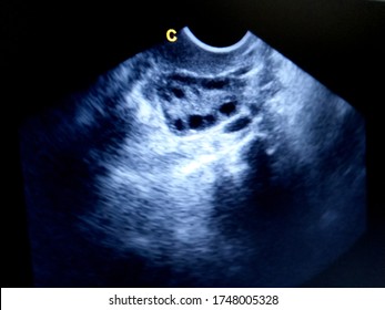 poly cystic ovary by ultrasound  - Shutterstock ID 1748005328