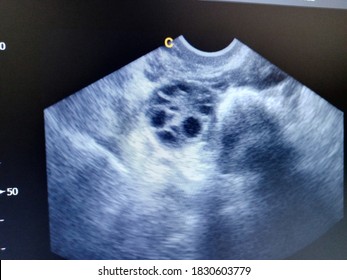 Poly Cystic Ovary By Ultrasound Scan