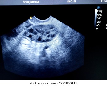 Poly Cystic Ovary By Ultrasound Scan