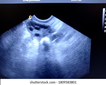 Polycystic Ovary By Ultrasound Scan