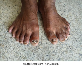 Polydactyly Of Foot.