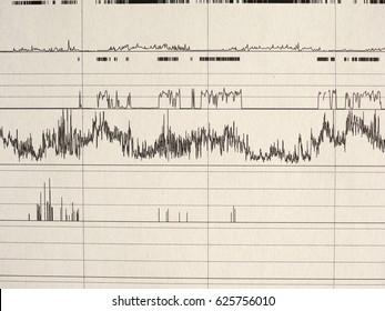 Polysomnography (PSG) Sleep Study Multi Parametric Test Diagnostic Tool