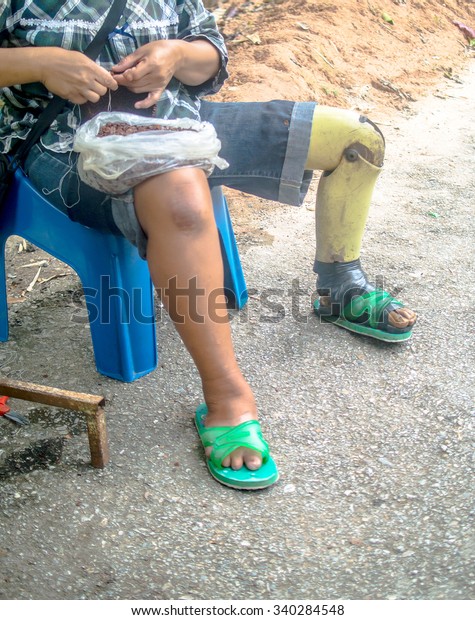 The poor amputee ,\
poor prosthesis using 