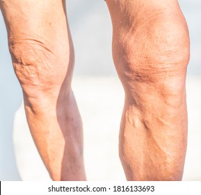 Poor Knee Joints Of The Elderly With Muscular Inflammation And Osteoarthritis.