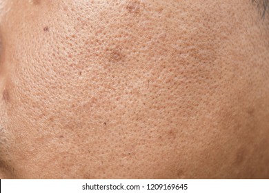 Pores And Oily On Surface Young Asian Man Face Skin Do Not Take Care For A Long Time