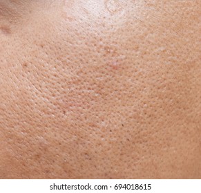 Pores And Oily On Surface Young Asian Man Face Skin Do Not Take Care For A Long Time