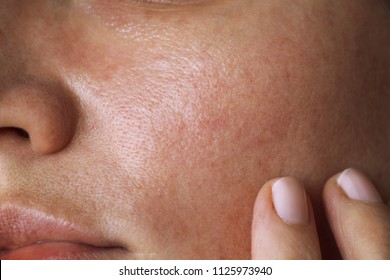 pores on the skin of the face. Cleansing the face skin