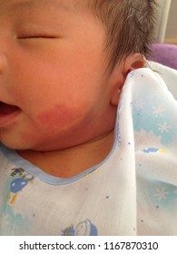 Port Wine Stain Or Naevus Flammeus  Red Birthmark On The Face Skin And Neck Baby Boy Case Of Vascular Malformation Seen In Newborn Of Treatment With Pulsed Dye Laser.