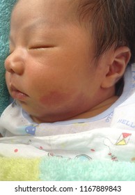 Port Wine Stain Or Naevus Flammeus  Red Birthmark On The Face Skin And Neck Baby Boy Case Of Vascular Malformation Seen In Newborn Of Treatment With Pulsed Dye Laser.