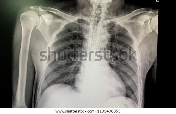 Portable Chest Xray Image Medical Diagnosis Stock Photo 1135498853 ...