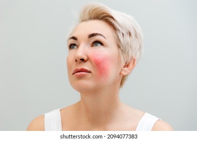 Portrait Of An Adult Beautiful Woman With Redness On Her Cheek. The Concept Of Rosacea And Aesthetic Medicine.