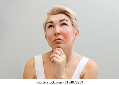 Portrait Of An Adult Thoughtful Beautiful Woman With Rosacea On Her Cheek. Gray Banner. Copy Space.