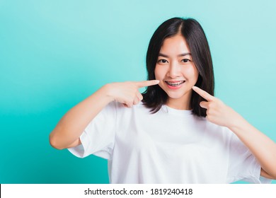 Portrait Of Asian Teen Beautiful Young Woman Smile Have Dental Braces On Teeth Laughing Point Finger Her Mouth, Studio Shot Isolated On A Blue Background, Medicine And Dentistry Concept