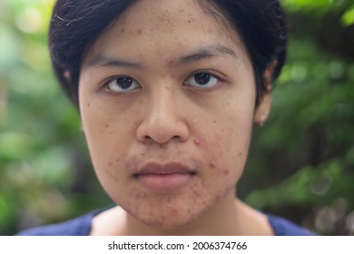 Portrait Asian Woman With Acne On The Face Caused By Wear A Face Mask During The Outbreak Of Covid-19 Coronavirus.