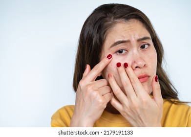 Portrait Of Asian Woman Worried About Her Acne And Wrinkled Occur On Her Face. Wrinkles Are Creases, Folds, Or Ridges In The Skin. They Naturally Appear As People Get Older.