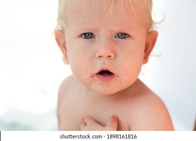 Portrait Of A Baby With A Rash Near The Mouth. Enterovirus, Allergy In A Child.
