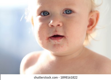 Portrait Of A Baby With A Rash Near The Mouth. Enterovirus, Allergy In A Child.
