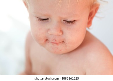 Portrait Of A Baby With A Rash Near The Mouth. Enterovirus, Allergy In A Child.
