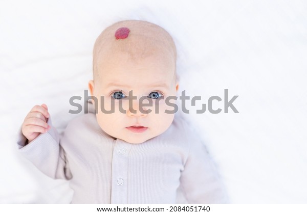 Hemangioma 552 Images Photos Et Images Vectorielles De Stock Shutterstock