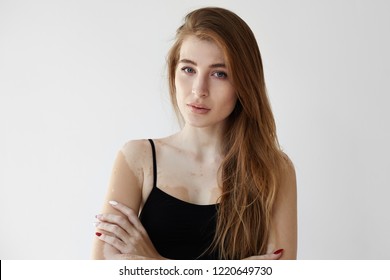 Vitiligo dating hem sida