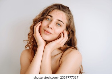 Portrait of a beautiful young woman with inflammations on the skin of her face. Medicine and cosmetology. Smiling woman with problem skin on a sunny day. Copy space.
