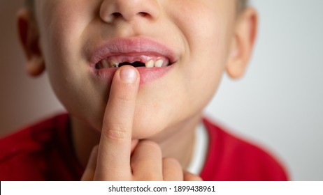 portrait of a boy with bad teeth, fallen front upper teeth