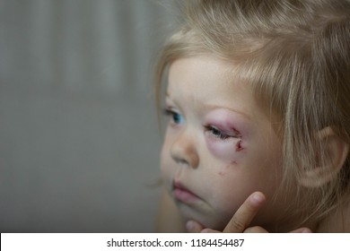 Portrait Of Caucasian Child Of Two Years Old With The Bruise On Face On Left Eye