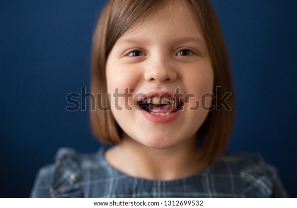 Portrait Child Girl Bracket On Teeth Stock Photo 1312699532 | Shutterstock