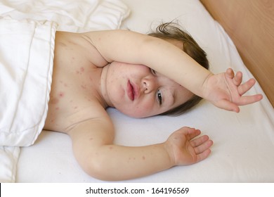 Portrait Of A  Child Lying In Bed  With Red Spots On His Skin Of Chicken Pox.