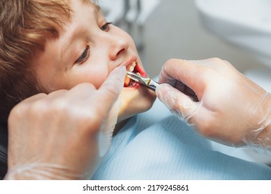 Portrait of a child patient and the hands of a pediatric dentist with dental forceps, close-up. painless extraction of teeth. pediatric dentistry.