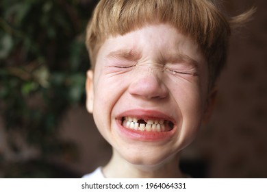 Portrait Of Crying Little Boy With Closed Eyes With Open Mouth Without One Front Tooth. Lost Or Knocked Out Tooth. Kid Cries In Pain And Fear. Waiting For Growth Of Permanent Tooth