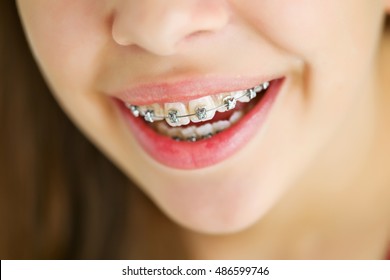 Portrait Of Cute Kid With Dental Braces Smiling.