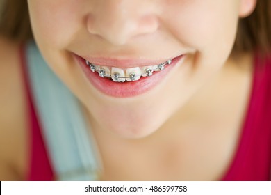 Portrait Of Cute Kid With Dental Braces Smiling.