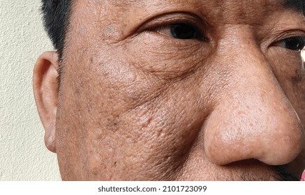 Portrait Dull Face And Rough Skin Of Middle-aged Man, Problem Skin Care, Cellulite And Pimple Under The Eyes.