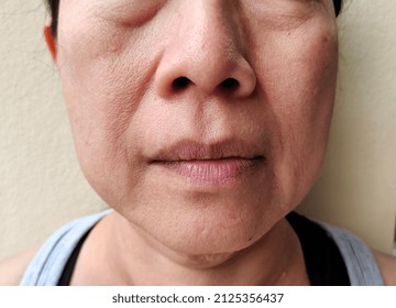 Portrait The Flabbiness Adipose Hanging Skin On The Face, Problem Flabby And Cellulite Skin Of The Woman, Concept Health Care.