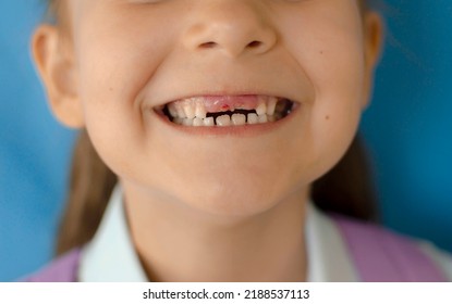 Portrait Of Girl With Missing Teeth. A Baby's Mouth Of Baby Without Front Milk Teeth. A Toothless Smile. Child Lost His Front Tooth. Tooth Fairy. Pediatric Dentistry, Dental Care, Go To The Dentist.