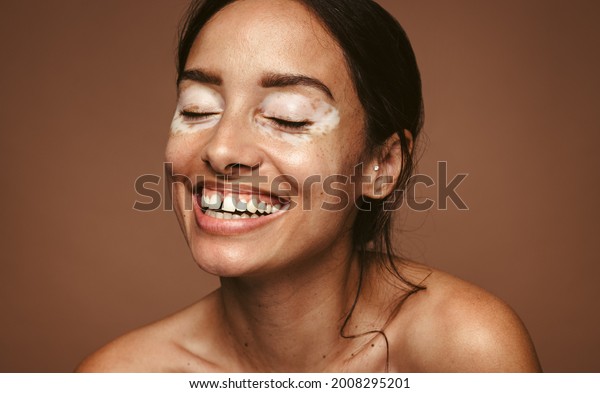 Portrait of happy woman with vitiligo against brown\
background. Close up of woman with skin disorder smiling with\
closed eyes.
